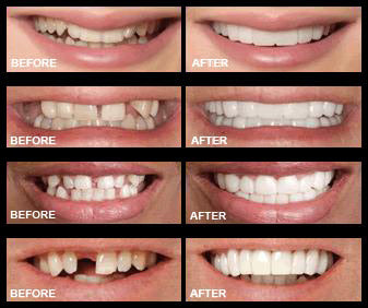Snap-On Smile Silicone Imitation Braces – Safe & Eco-Friendly Teeth Decoration