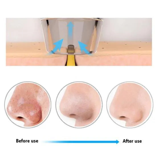 5 in 1 Electric Blackhead Acne Oil Remover Vacuum Suction Face Pore Cleaner Machine