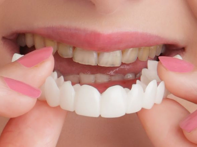 Snap-On Smile Silicone Imitation Braces – Safe & Eco-Friendly Teeth Decoration
